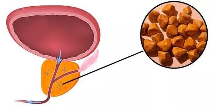 Prostate stones