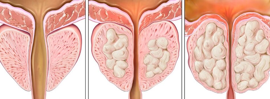 Prostatitis phase